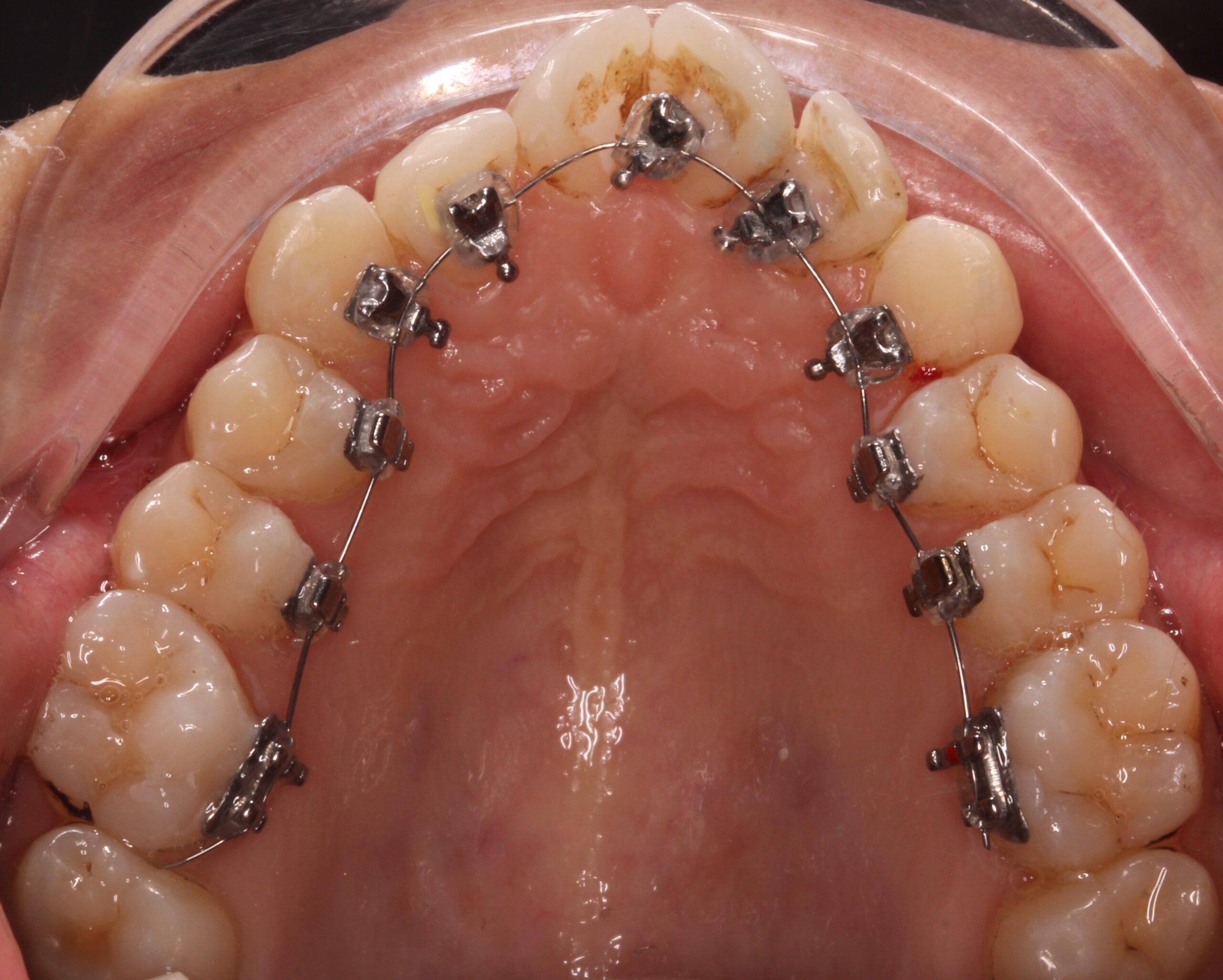 Braces Placed Behind the Teeth