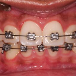 traditional metal braces to correct the alignment of teeth