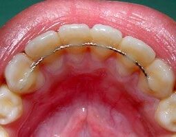 Retainer Cost in Nepal