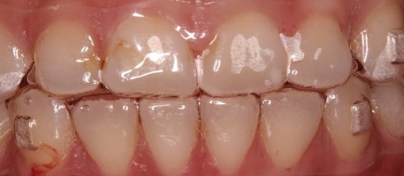 Aligners Invisalign treatment in Nepal