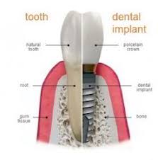 Dental Implant