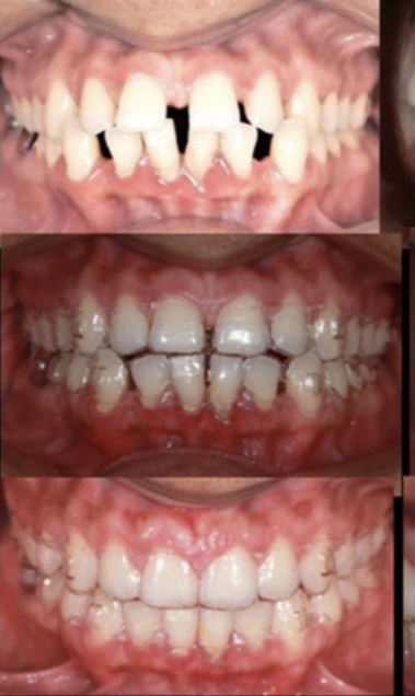 clear aligners in Kathmandu Nepal