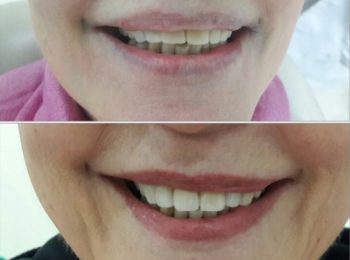 Porcelain Veneer