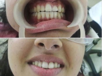 Gum lifting done