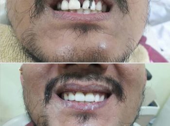 Zirconia Bridge