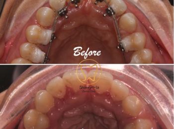 lingual-braces-nepal