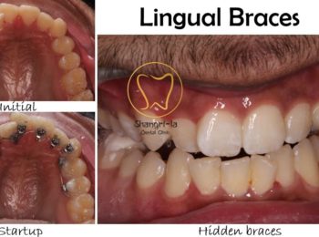 Lingual Braces