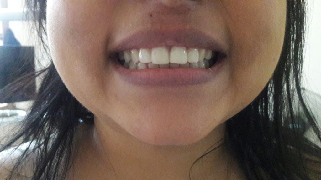 After picture of Porcelain (Emax) Veneer