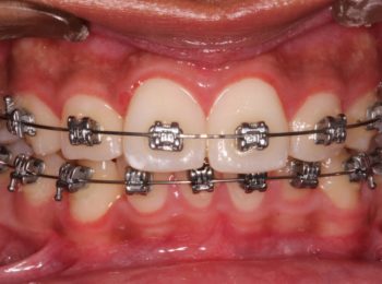Braces in Kathmandu