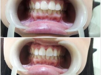 Porcelain Veneers