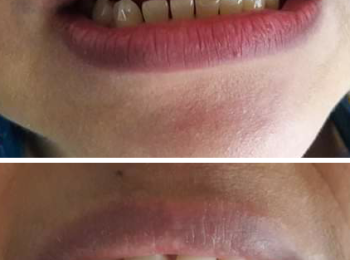 Porcelain Veneers