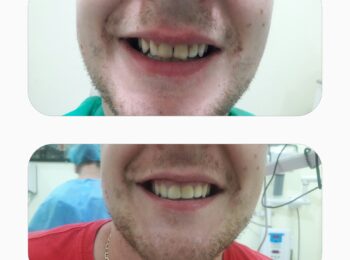 Porcelain Veneer