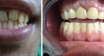 Zirconia Crown