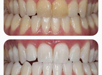 teeth whitening makes your yellow teeth whiter and brighter
