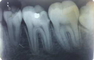 Intra-oral Peri-apical Dental X-ray (IOPA)