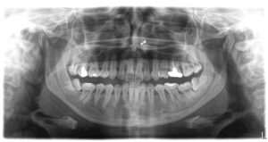 OPG dental X-ray showing impacted wisdom tooth on both sides of lower jaw.