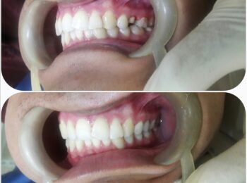 emax-dental-crown