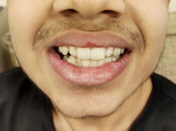 Aligners