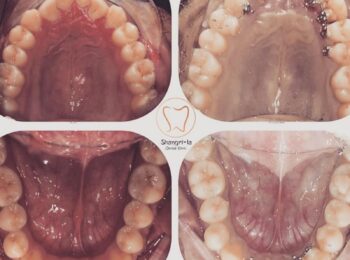 BEHIND THE TEETH BRACES