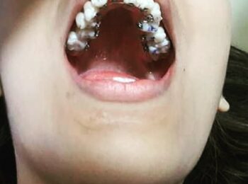 Lingual Braces