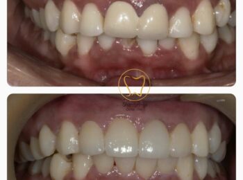 smile makeover