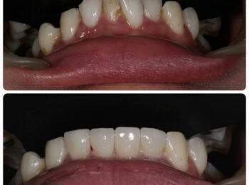 Teeth alignment without Braces