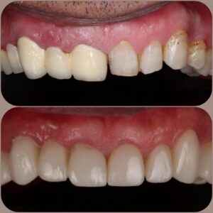 Zirconia Crown Nepal/Cosmetic Dentist